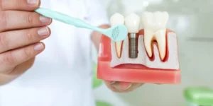 blog How to Choose the Right Dental Implants in Killeen, TX
