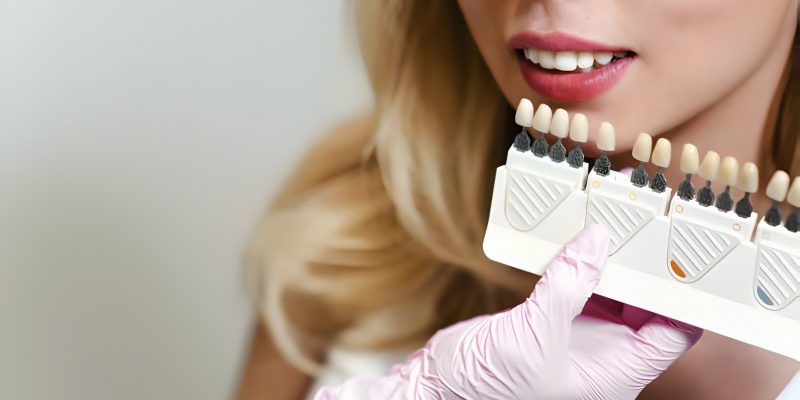 Veneers Treatment in Texas: 7 Things You Need to Know