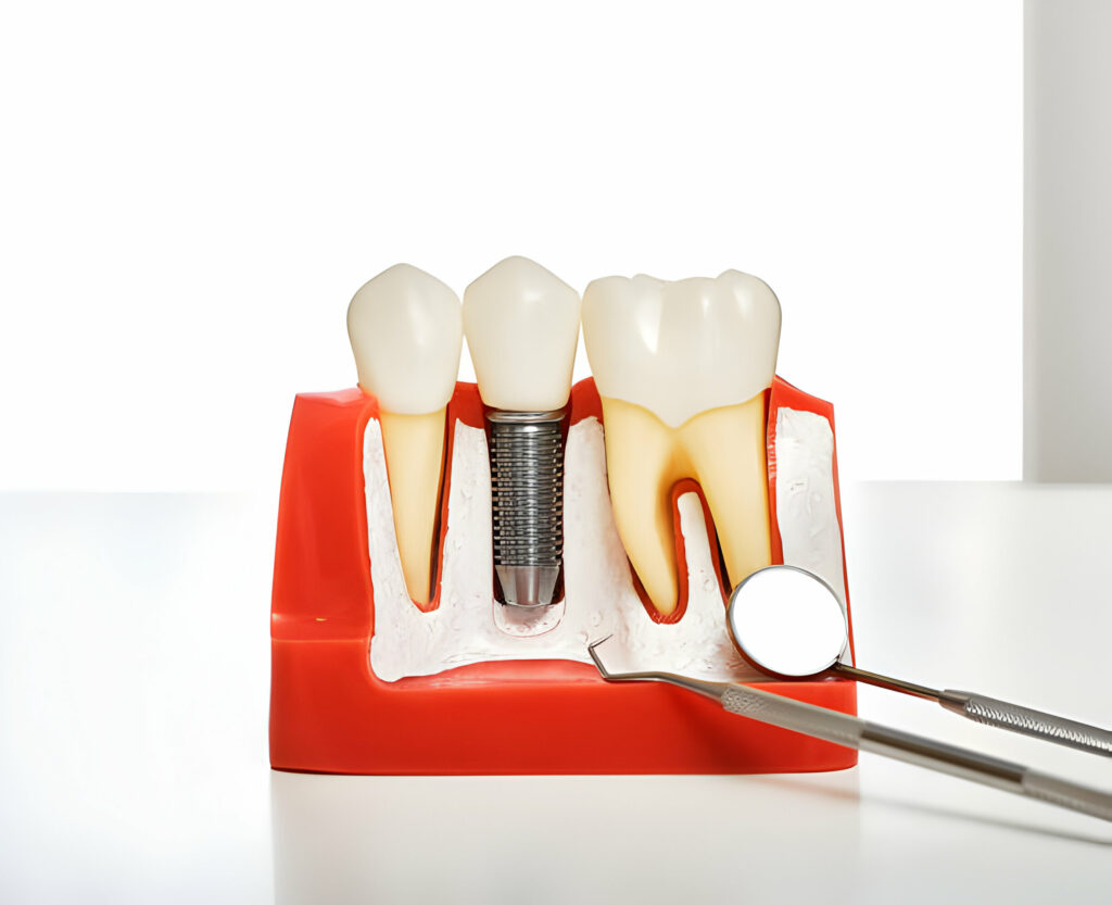 How to Choose the Right Dental Implants in Killeen, TX_2