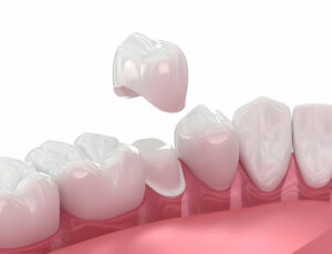 How to Choose the Right Dental Implants in Killeen, TX_FI