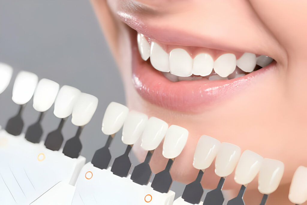 Why Should You Consider Teeth Whitening In Killeen, TX_3