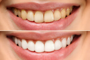 Why Should You Consider Teeth Whitening In Killeen, TX_FI