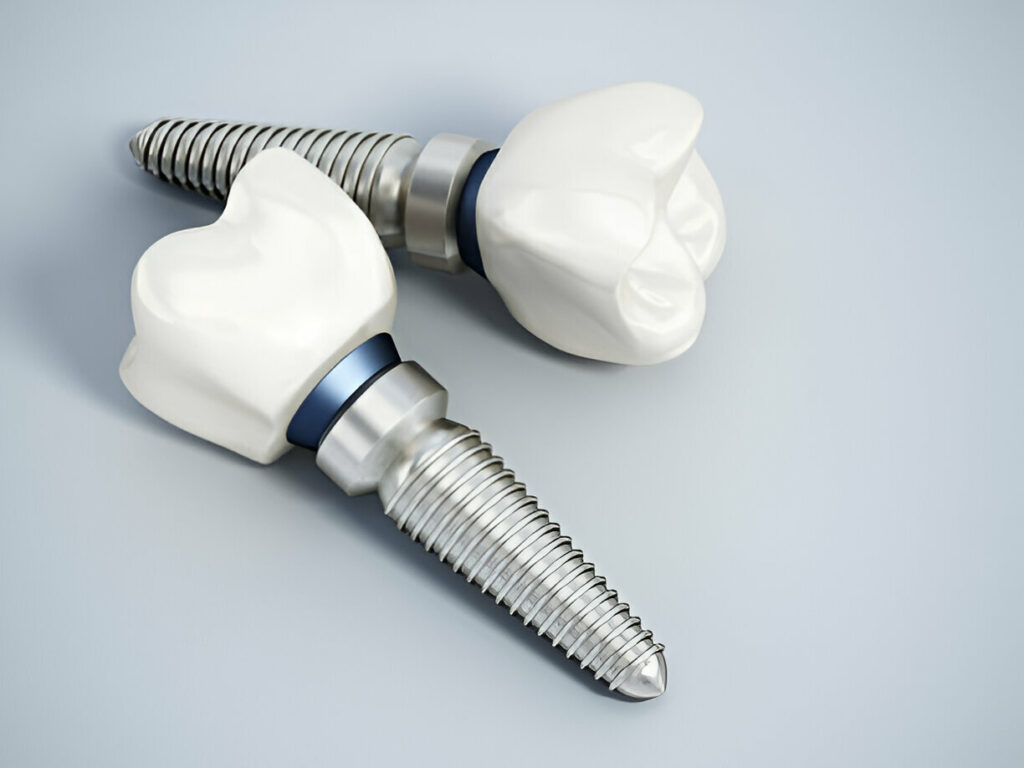 Dental Implants in Killeen, TX: What You Need to Know About Killeen Dental Group's Expert Care_FI