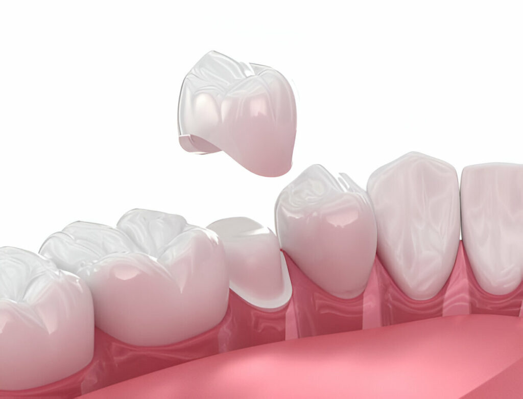 Dental Crowns in Killeen, TX Materials, Process & Aftercare Guide