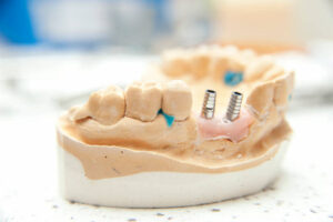 Maintaining Your Dental Implants for a Lifetime Smile in Killeen, TX