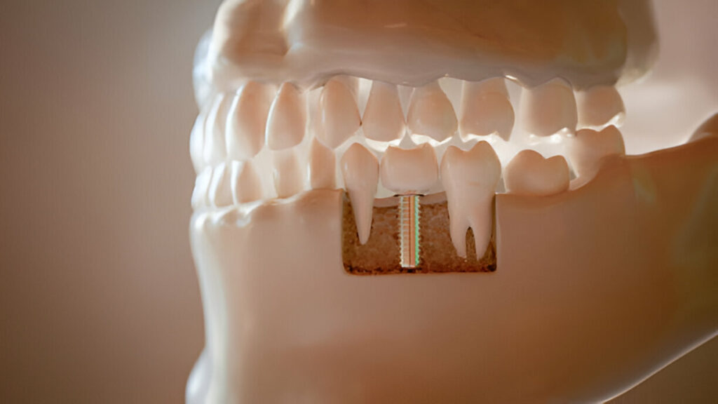 What to Expect During a Dental Implant Procedure at Killeen Dental Group_FI